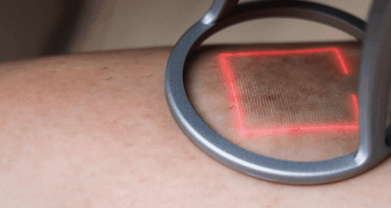 FRACTIONAL CO₂ LASER RESURFACING