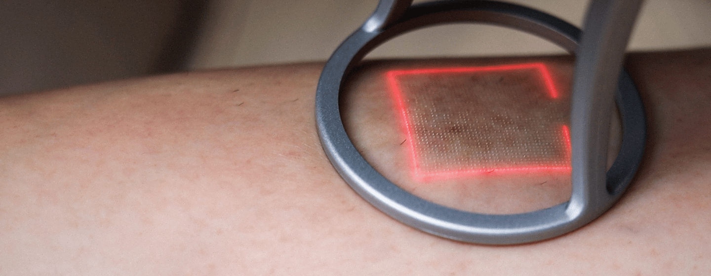 Fractional CO₂ Laser Resurfacing